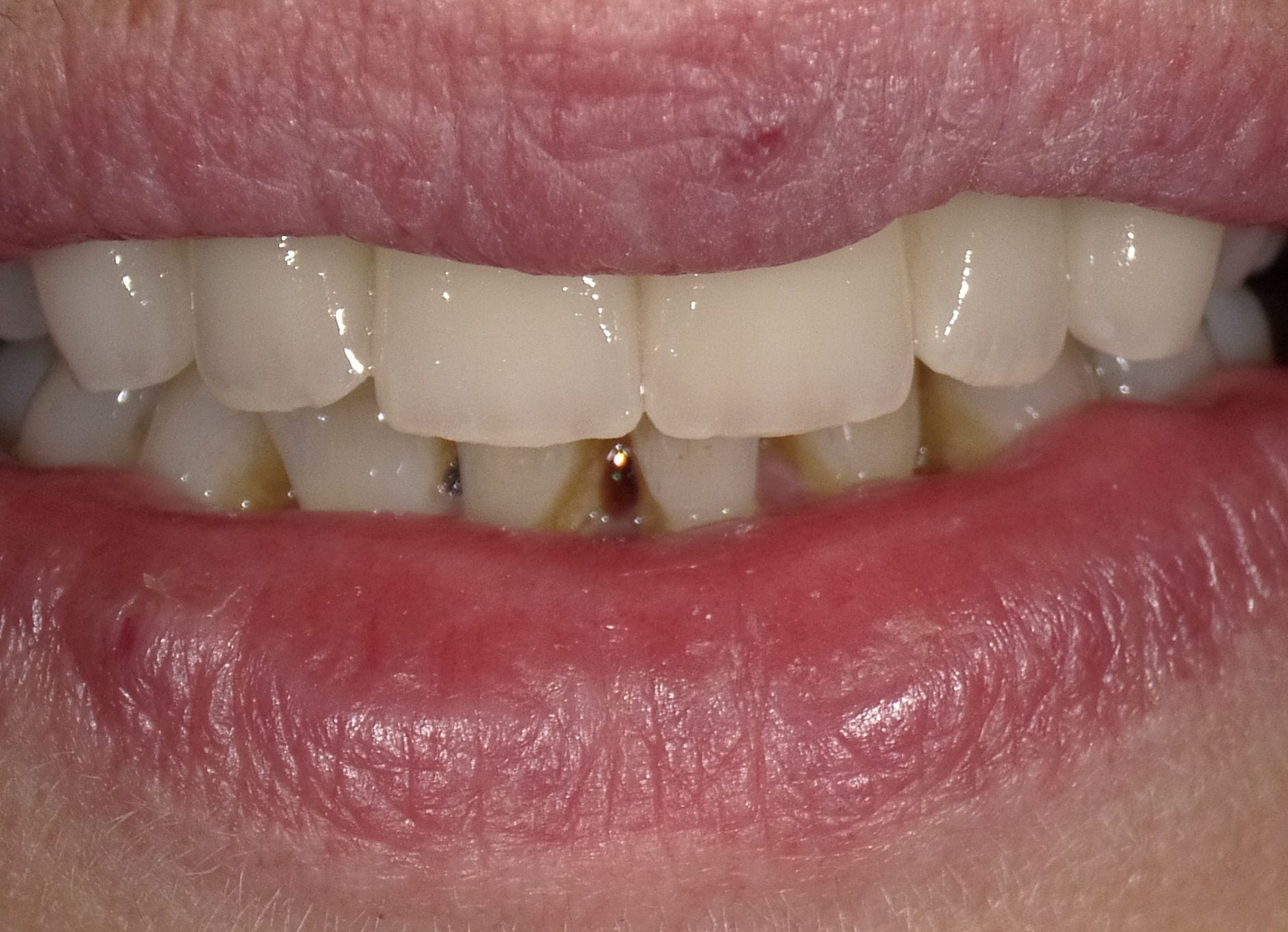 Formkorrektur mit Kronen und Veneers